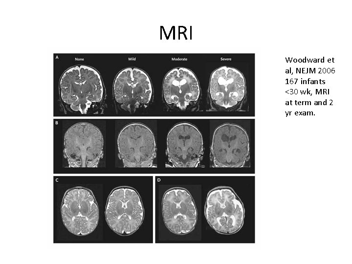 MRI Woodward et al, NEJM 2006 167 infants <30 wk, MRI at term and