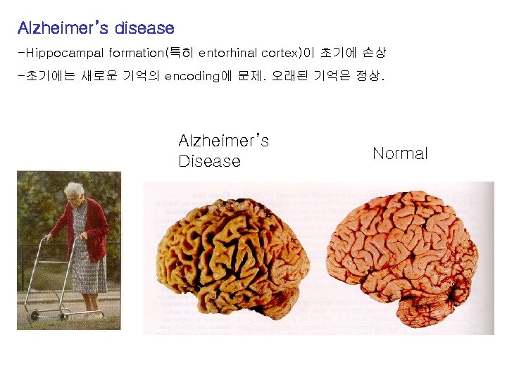 Alzheimer’s disease -Hippocampal formation(특히 entorhinal cortex)이 초기에 손상 -초기에는 새로운 기억의 encoding에 문제. 오래된
