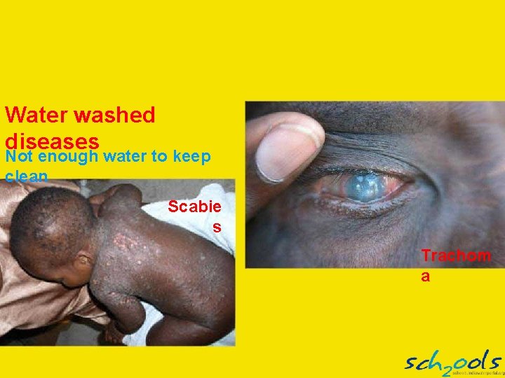 Water washed diseases Not enough water to keep clean Scabie s Trachom a 