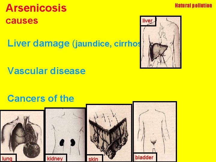 Arsenicosis Natural pollution causes liver Liver damage (jaundice, cirrhosis) Vascular disease Cancers of the