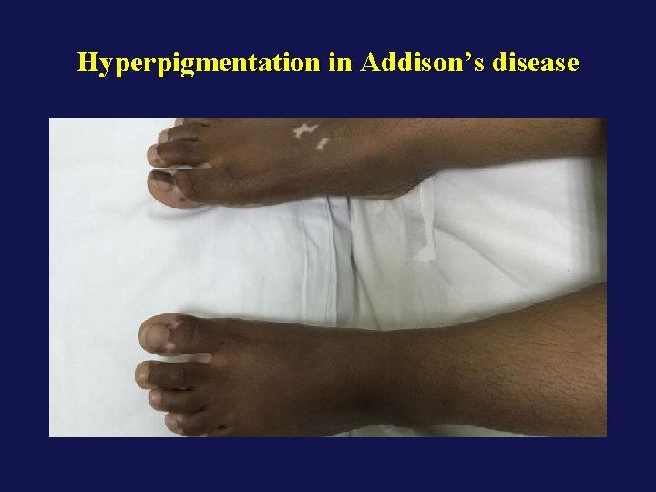 Hyperpigmentation in Addison’s disease 