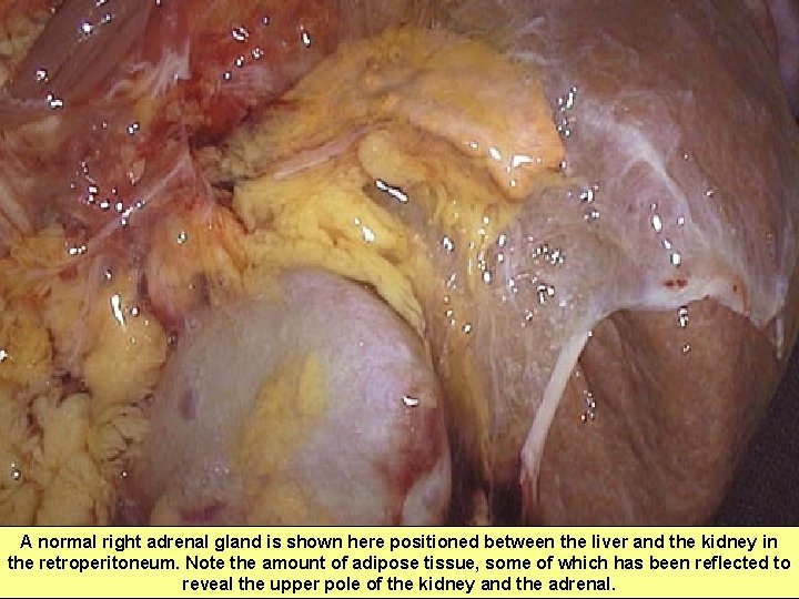 A normal right adrenal gland is shown here positioned between the liver and the