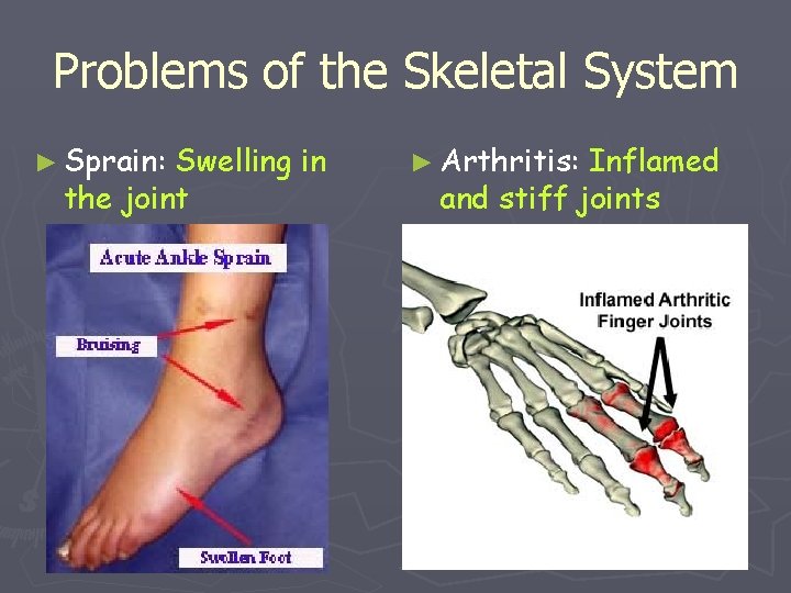 Problems of the Skeletal System ► Sprain: Swelling in the joint ► Arthritis: Inflamed