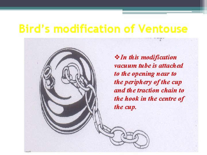 Bird’s modification of Ventouse v. In this modification vacuum tube is attached to the