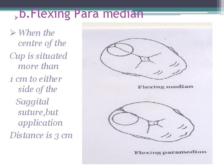 Ø b. Flexing Para median Ø When the centre of the Cup is situated