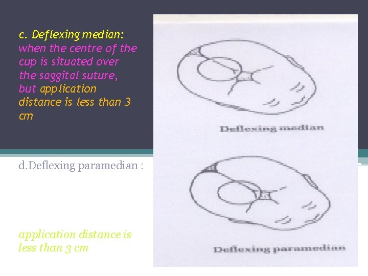 c. Deflexing median: when the centre of the cup is situated over the saggital