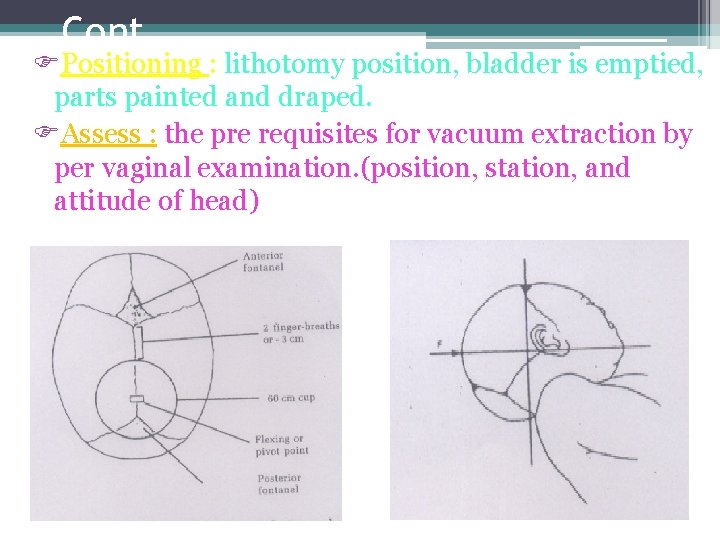 Cont… Positioning : lithotomy position, bladder is emptied, parts painted and draped. Assess :