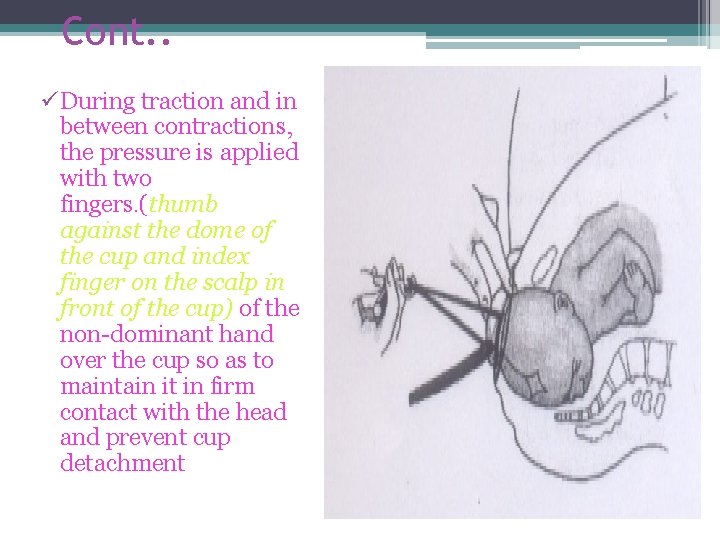Cont. . ü During traction and in between contractions, the pressure is applied with