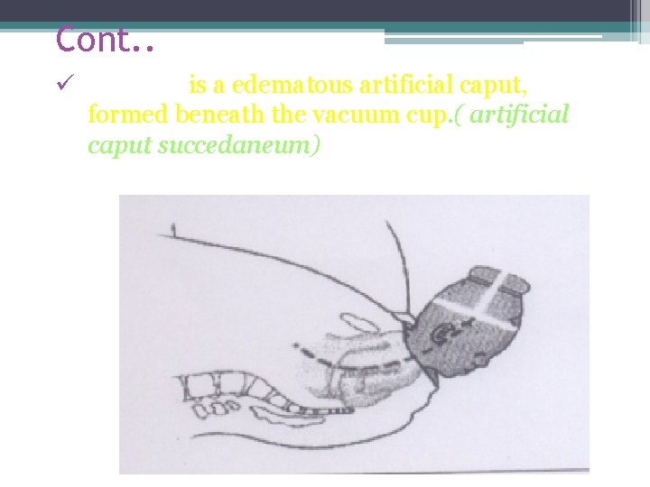 Cont. . ü Chignon is a edematous artificial caput, formed beneath the vacuum cup.