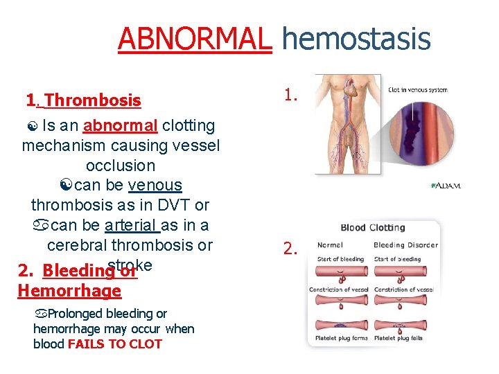 ABNORMAL hemostasis 1. Thrombosis Is an abnormal clotting mechanism causing vessel occlusion can be