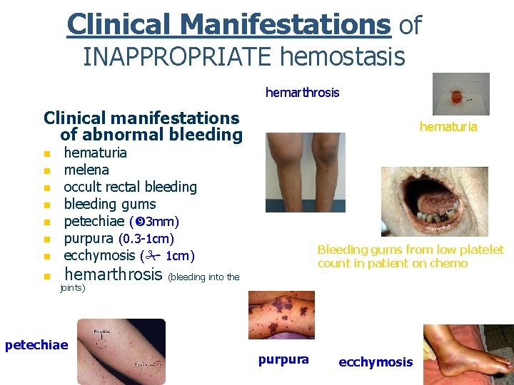 Clinical Manifestations of INAPPROPRIATE hemostasis hemarthrosis Clinical manifestations of abnormal bleeding n n n