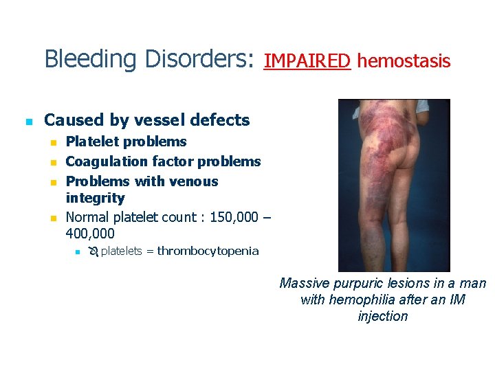 Bleeding Disorders: IMPAIRED hemostasis n Caused by vessel defects n n Platelet problems Coagulation