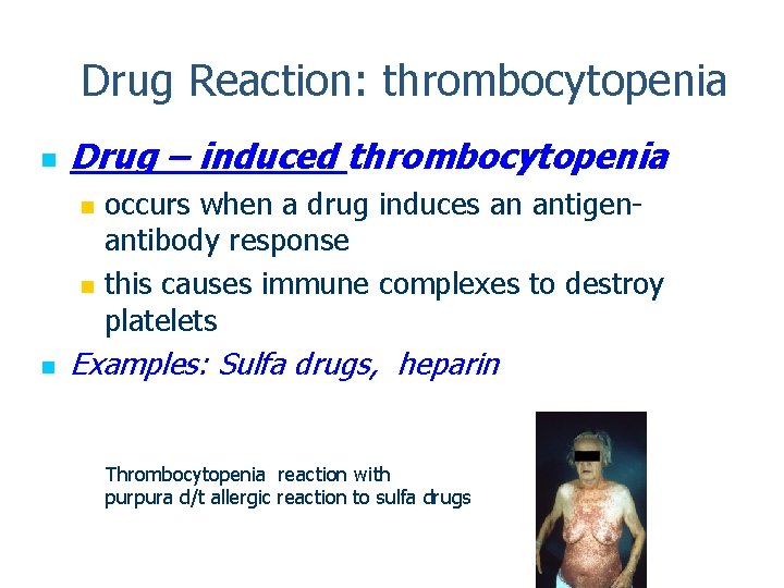 Drug Reaction: thrombocytopenia n Drug – induced thrombocytopenia occurs when a drug induces an
