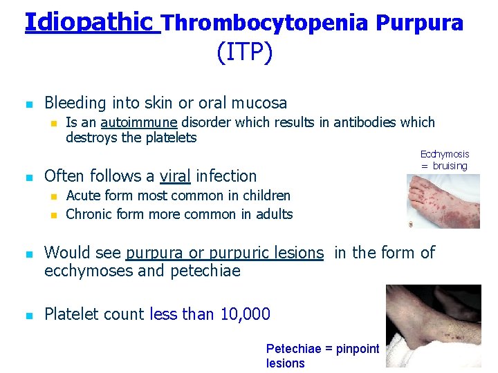 Idiopathic Thrombocytopenia Purpura (ITP) n Bleeding into skin or oral mucosa n n Ecchymosis