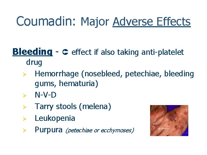 Coumadin: Major Adverse Effects Bleeding - effect if also taking anti-platelet drug Ø Hemorrhage