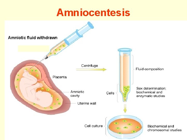 Amniocentesis Amniotic fluid withdrawn 