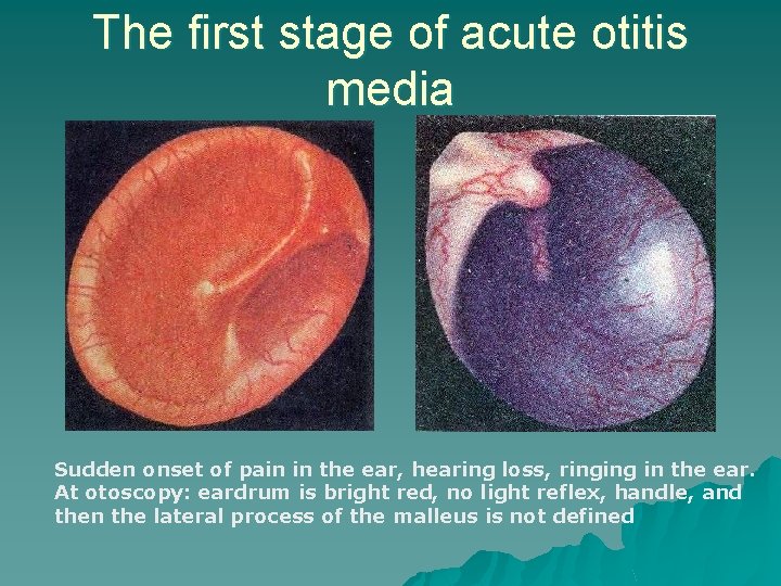 The first stage of acute otitis media Sudden onset of pain in the ear,