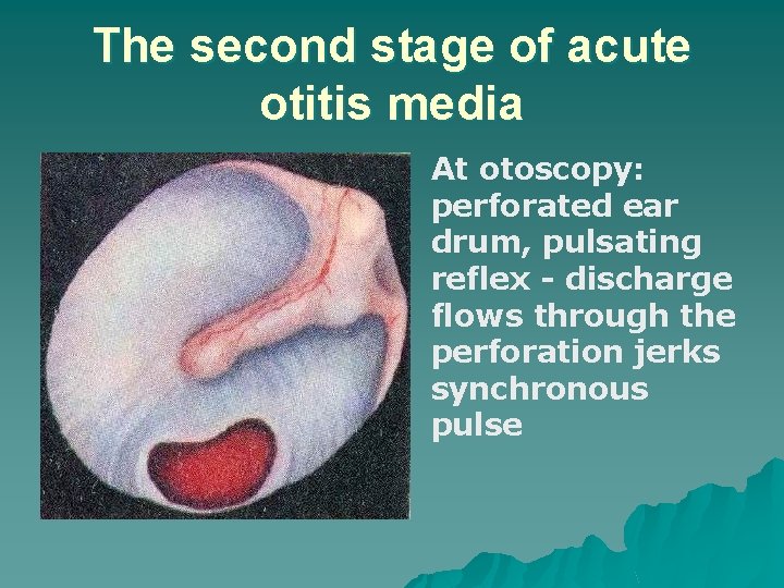 The second stage of acute otitis media At otoscopy: perforated ear drum, pulsating reflex