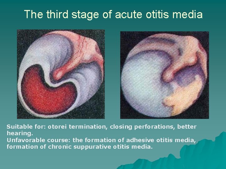 The third stage of acute otitis media Suitable for: otorei termination, closing perforations, better