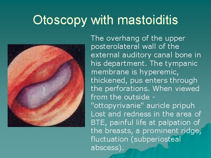 Otoscopy with mastoiditis The overhang of the upper posterolateral wall of the external auditory