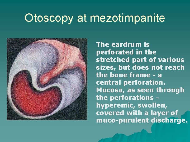 Otoscopy at mezotimpanite The eardrum is perforated in the stretched part of various sizes,