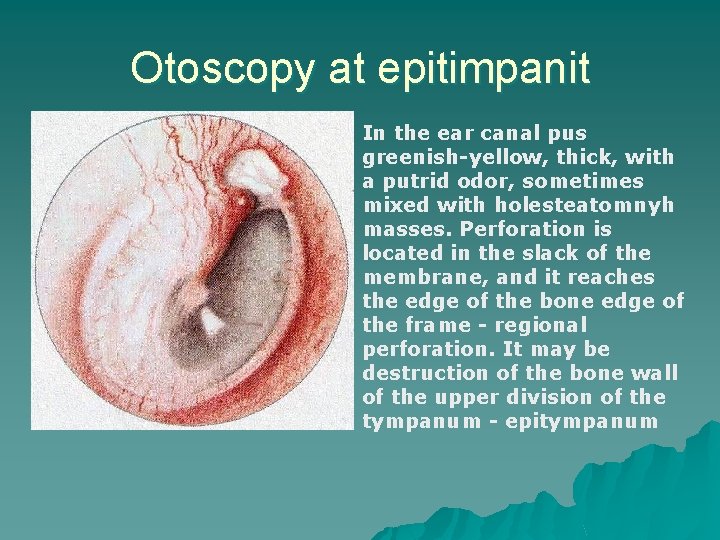 Otoscopy at epitimpanit In the ear canal pus greenish-yellow, thick, with a putrid odor,