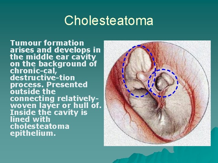 Cholesteatoma Tumour formation arises and develops in the middle ear cavity on the background