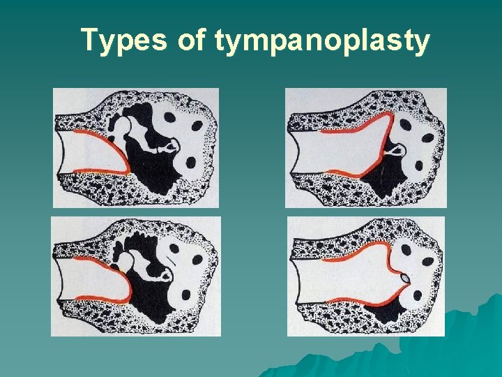 Types of tympanoplasty 