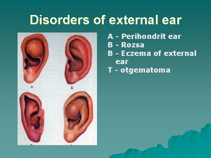 Disorders of external ear A - Perihondrit ear B - Rozsa B - Eczema