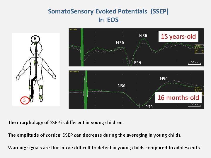 Somato. Sensory Evoked Potentials (SSEP) In EOS N 50 N 30 15 years-old P