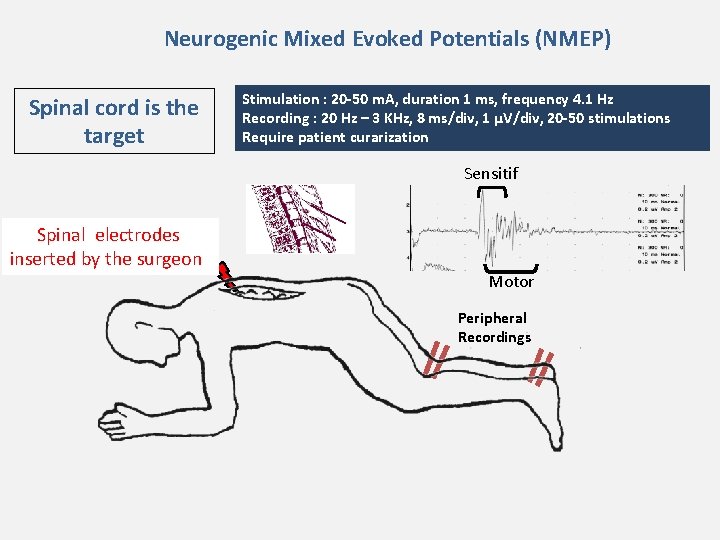 Neurogenic Mixed Evoked Potentials (NMEP) Spinal cord is the target Stimulation : 20 -50