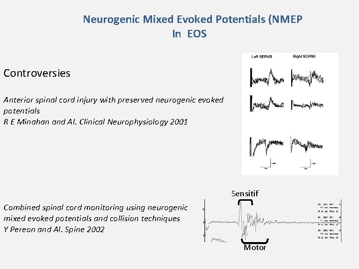 Neurogenic Mixed Evoked Potentials (NMEP In EOS Controversies Anterior spinal cord injury with preserved