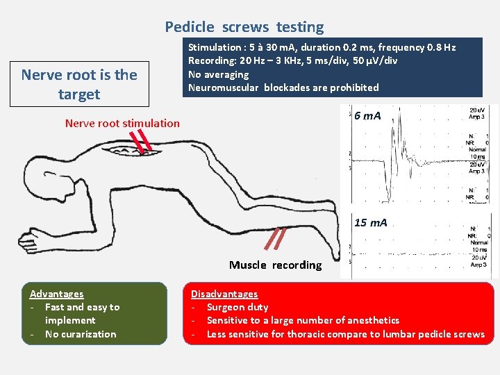 Pedicle screws testing Nerve root is the target Stimulation : 5 à 30 m.