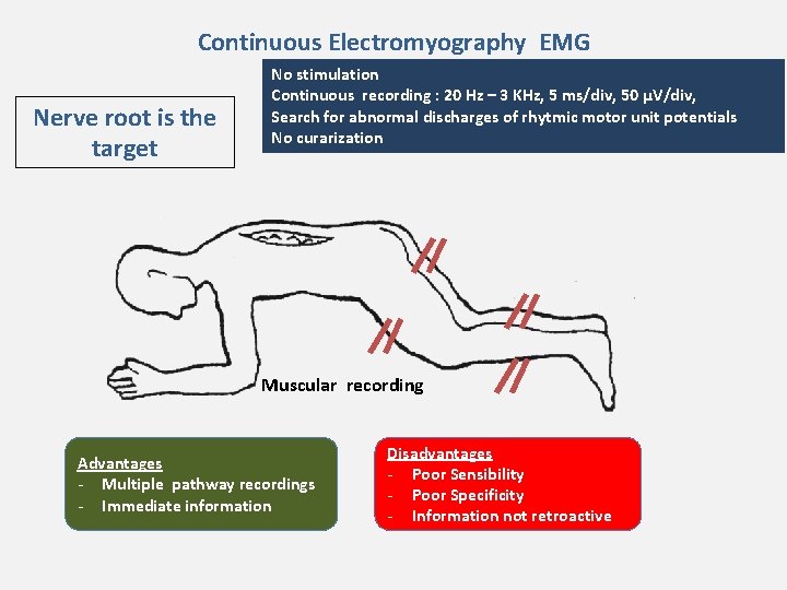 Continuous Electromyography EMG Nerve root is the target No stimulation Continuous recording : 20