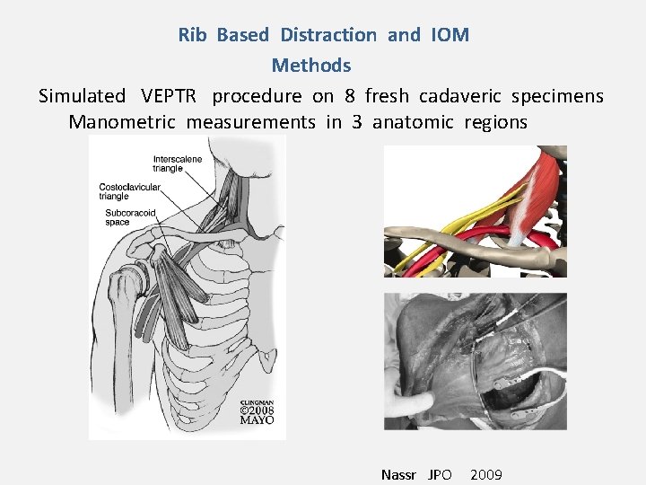 Rib Based Distraction and IOM Methods Simulated VEPTR procedure on 8 fresh cadaveric specimens