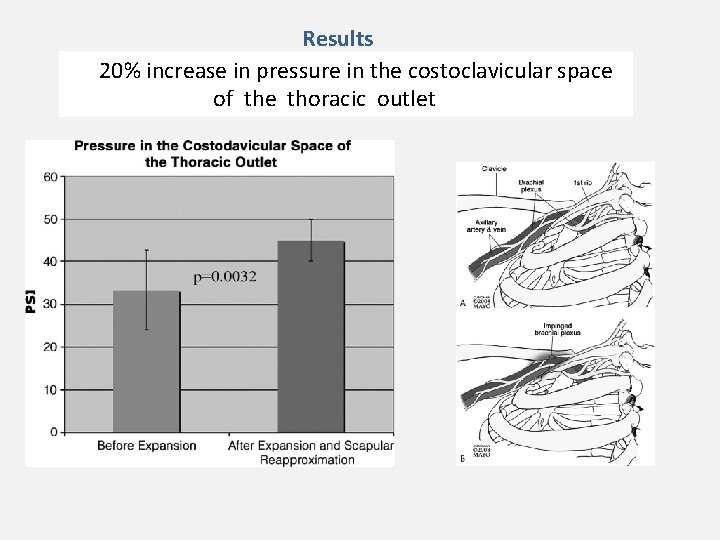 Results 20% increase in pressure in the costoclavicular space of the thoracic outlet 