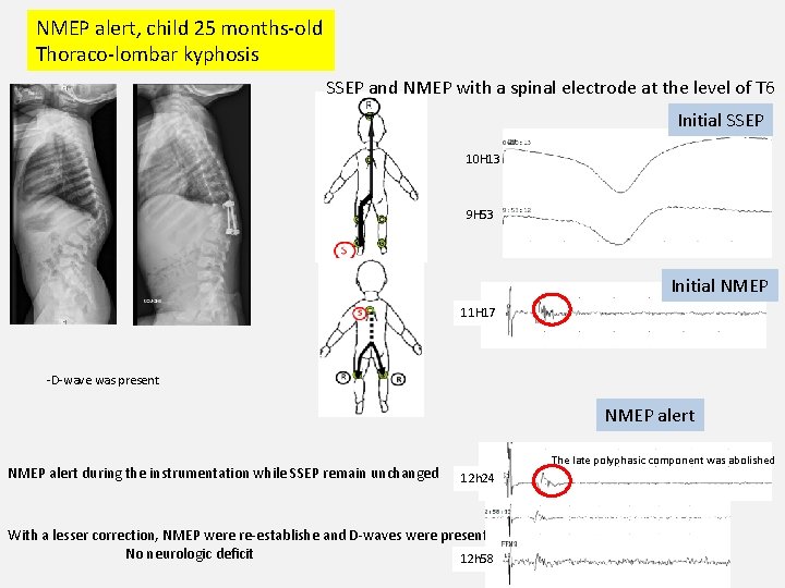 NMEP alert, child 25 months-old Thoraco-lombar kyphosis SSEP and NMEP with a spinal electrode