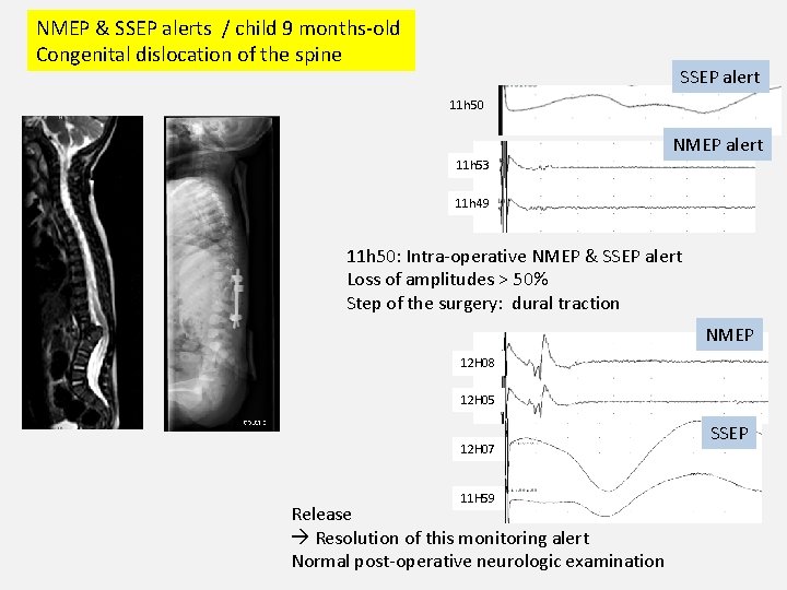 NMEP & SSEP alerts / child 9 months-old Congenital dislocation of the spine SSEP