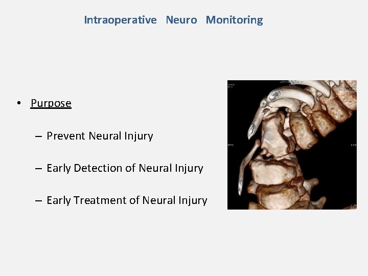 Intraoperative Neuro Monitoring • Purpose – Prevent Neural Injury – Early Detection of Neural