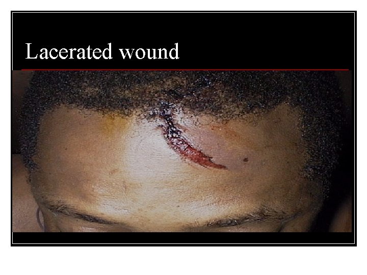 Lacerated wound 