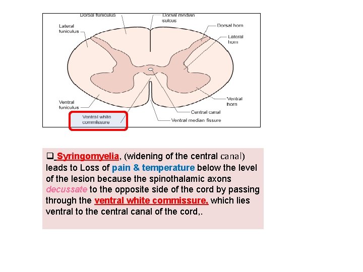 q Syringomyelia, (widening of the central canal) leads to Loss of pain & temperature