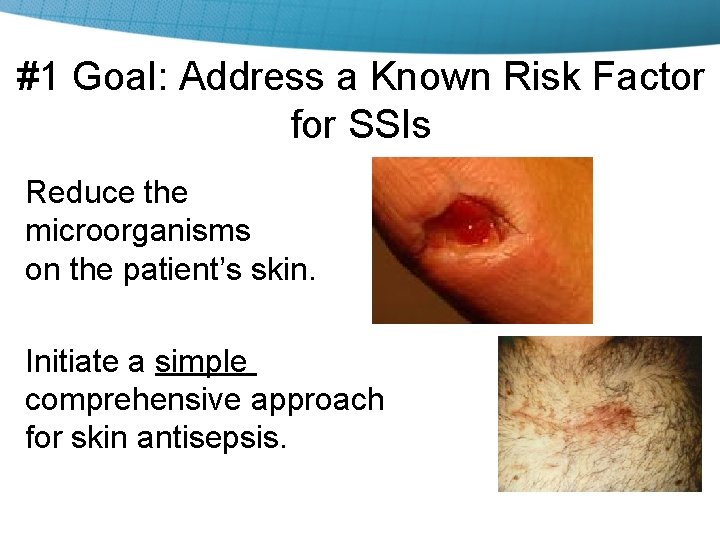 #1 Goal: Address a Known Risk Factor for SSIs Reduce the microorganisms on the