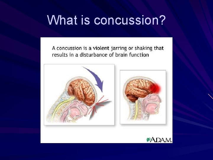 What is concussion? 