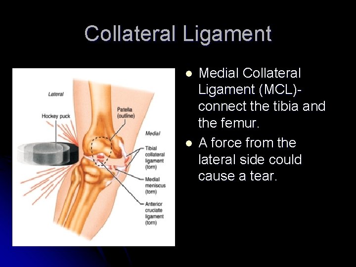 Collateral Ligament l l Medial Collateral Ligament (MCL)connect the tibia and the femur. A
