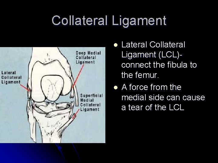 Collateral Ligament l l Lateral Collateral Ligament (LCL)connect the fibula to the femur. A