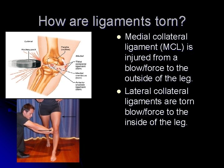 How are ligaments torn? l l Medial collateral ligament (MCL) is injured from a