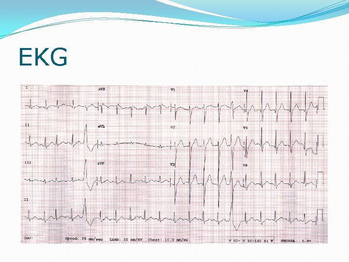 EKG 