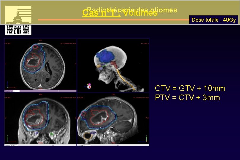 Radiothérapie des gliomes Cas n° 1 : Volumes Dose totale : 40 Gy CTV