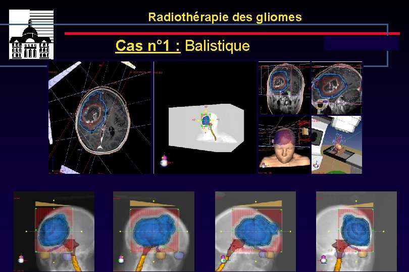 Radiothérapie des gliomes Cas n° 1 : Balistique Dose totale : 40 Gy 