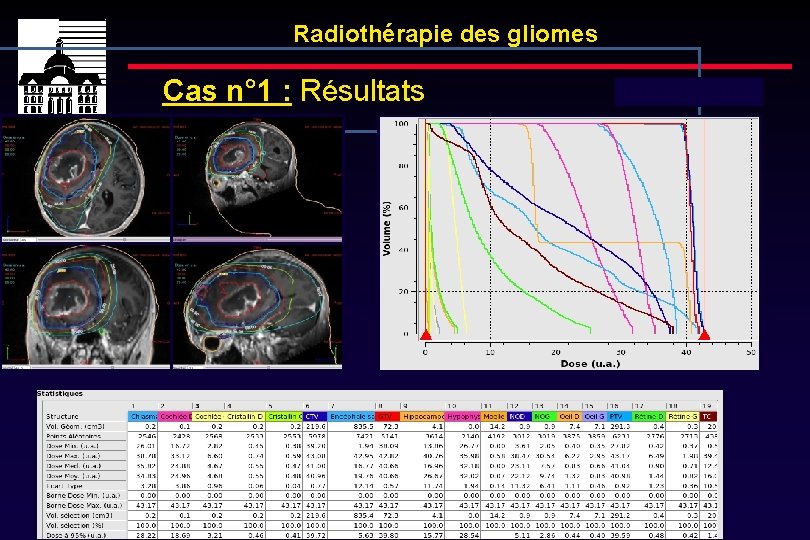 Radiothérapie des gliomes Cas n° 1 : Résultats Dose totale : 40 Gy 